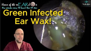 GREEN INFECTED EAR WAX 249 ear earwax earwaxremoval earcleaning asmr fyp foryou satisfying [upl. by Yntrok]