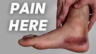 Deltoid Ligament Sprain EXERCISES Causes Symptoms Diagnosis and Treatment [upl. by Donella]