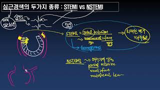 심근경색의 두가지 종류  STEMI와 NSTEMI [upl. by Ihskaneem]