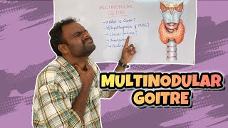 MULTINODULAR GOITRE  THYROID  MEDICINE  SURGERY  SHEELAM SRUJAN [upl. by Lj]