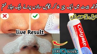 How To Remove BLACKHEADS at Home  In Just 5 Mints Best Way to Remove BLACKHEADS With Toothpaste [upl. by Ylnevaeh]