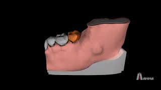 Animation  Dentigerous Cyst 3D Model [upl. by Eirual]