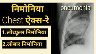 How To Read Chest XRay  Pneumonia Symptoms  Pneumonia X ray  Lobar Pneumonia  CXR in hindi [upl. by Ahtanoj]