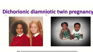 Anatomy of dichorionic and diamniotic twin pregnancy with sonographic feature twin obimagesnet [upl. by Enytsirhc327]