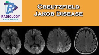 CreutzfieldJakobDisease [upl. by Rolf396]