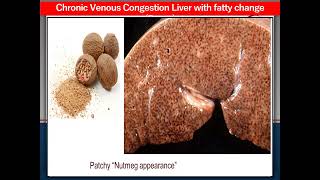 Bilharziasis UB Chronic venous congestion liver fatty change  Chronic rheumatic valvulitis [upl. by Einafpets661]