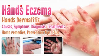 Eczema Hands overview causes sign and symptoms diagnosis treatment home remedies FAQs extend [upl. by Levesque]