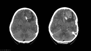 Oligodendroglioma [upl. by Edmund376]