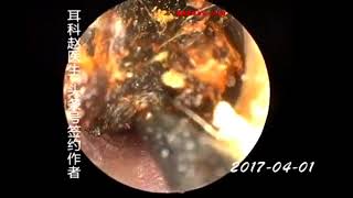 Earwax Removal Extractions More Than 50 Years Old Earwax 50年窖藏 外耳道挖耳屎清理 耳垢 耳垢 [upl. by Bronny]