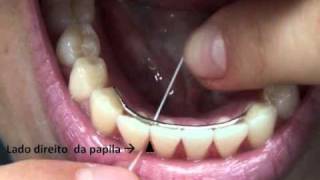 Como Passar Fio Dental no Dente com Aparelho  Orlando Tanaka [upl. by Lowndes]