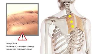 Shoulders Trigger Point Injection  Auburn Medical Group [upl. by Enyr]