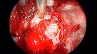 pituitary adenoma endoscopic endonasal Demo [upl. by Abdu]