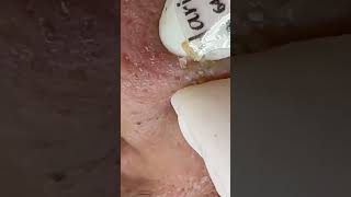 Extraction profonde des points noirs Acné kystique et popping 9 [upl. by Nylssej]