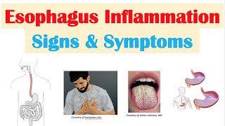 Esophagitis Esophagus Inflammation Signs amp Symptoms amp Why They Occur [upl. by Eisdnil214]