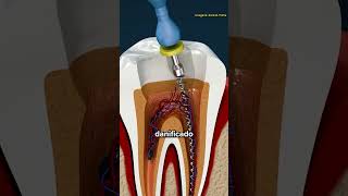 Como É Feito Um Canal no Dente [upl. by Weaver]