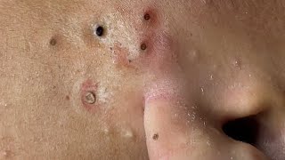 Big Cystic Acne Blackheads Extraction Blackheads amp Milia Whiteheads Removal Pimple Popping  1248 [upl. by Allistir442]