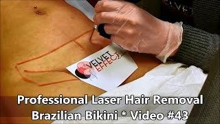 Professional Laser Hair Removal  Brazilian Bikini  Video 43 [upl. by Eggleston]