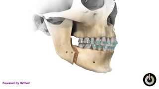 BSSO Mandibular Advancement Transcortical [upl. by Dusza]