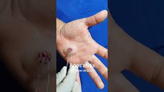 Botfly Maggot Removal spa doctor satisfying pimple removal [upl. by Sontich]