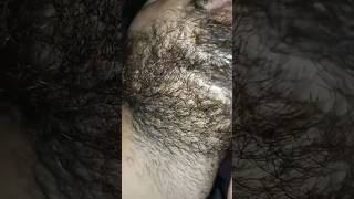 beard hair longer Carly problem beard hairproblem barber barbershop ingrownhair hairremoval [upl. by Iolenta]