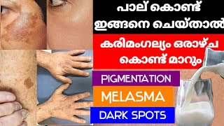 കരിമംഗല്യം മാറ്റാൻ എളുപ്പ വഴി  karimangalyam Pigmentation Melasma melasma [upl. by Serena]