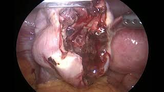 hemorrhagic ovarian cyst [upl. by Neely]