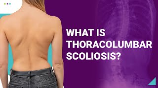 What is Thoracolumbar Scoliosis [upl. by Annawad]