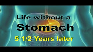 Esophagectomy 5 12 years later [upl. by Ytomit968]