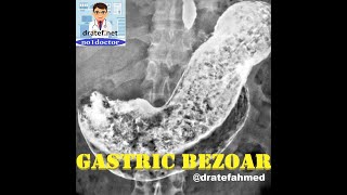 Gastric Bezoar CausesSymptoms and signs Diagnosis Bezoar Removal Endoscopic SurgicalNo1doctor [upl. by Reyotal]