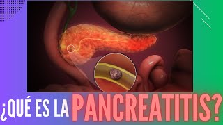 ¿Qué es la pancreatitis [upl. by Lilli]