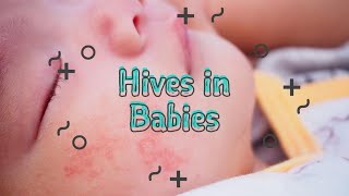 Baby Hives  allergies and skin rash [upl. by Annaya]