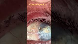 Corneal opacity after keratoplasty [upl. by Cass]