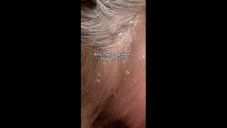 Itchy flaky scalp Heres how to fix it 💧  BeKynd Beauty shorts [upl. by Dobbins439]