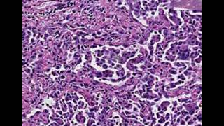 Histopathology LungDesquamative interstitial pneumonia [upl. by Aiker]