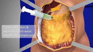 Exploratory Laparotomy  3D Medical Animation  Part  1  Films Blueray [upl. by Aratak]