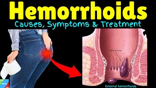 Hemorrhoids  Haemorrhoids  Piles  Hemorrhoidal Disease – Signs amp Symptoms Causes Treatment [upl. by Ikaz]