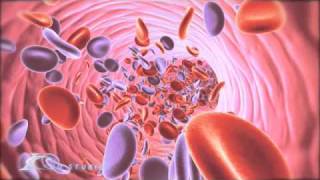 Eisenmenger Syndrome Medical Animation [upl. by Mckenna]