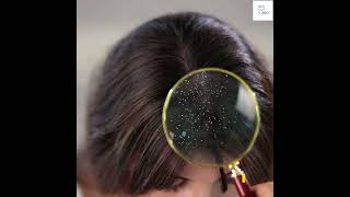 Dandruff Top 7 Natural Solutions [upl. by Amy]