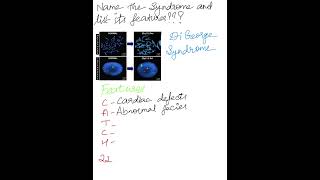 Identify The Syndrome and List the Features Syndromes MedicalMnemonics [upl. by Ettedo]