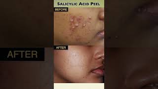 Effective Salicylic Peel Results 😍  Best Treatment for Hyperpigmentation Acne and Pimple Marks [upl. by Elisee330]