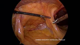 CME amp CVL FOR HEPATIC FLEXURE CA WITH VOICE [upl. by Ralston]