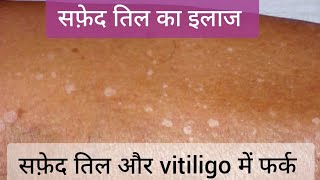 Idiopathic Guttate Hypomelanosis IGH सफ़ेद तिल और Vitiligo  Leucoderma और IGH vitiligo leucoderma [upl. by Dibbrun]