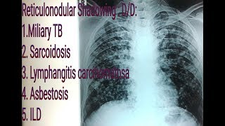 Reticulonodular shadowingopacity on Chest X Ray  Miliary Tuberculosis VS Sarcoidosis [upl. by Arabeila391]