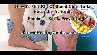 Blood Clots In Legs Treatment At Home How To Dissolve Blood Clots In Legs Naturally [upl. by Kristyn588]