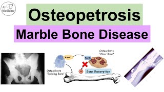 Osteopetrosis Marble Bone Disease  Causes Symptoms Diagnosis Treatment [upl. by Meagher421]