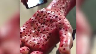 Do You Have Trypophobia The Fear of Holes  The Doctors [upl. by Lenrow]