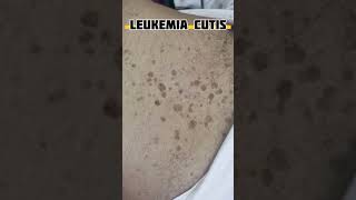 Chronic lymphocytic leukemia mrmc CLL leukimia pathology ⁴ [upl. by Ynelram491]