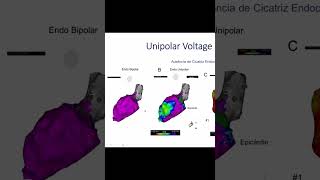 El Poder del Mapa Unipolar Detectando Cicatrices Ocultas en el Corazón Dra Carina Hardy [upl. by Notlem]