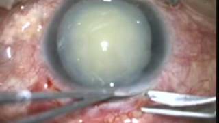 Anterior luxation of the lens Ectopia lentis Intracapsular Surgery [upl. by Yllen599]