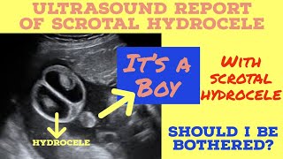 Fetal Scrotal Hydrocele ultrasoundreport Its a boy Ultrasound [upl. by Ladnek318]